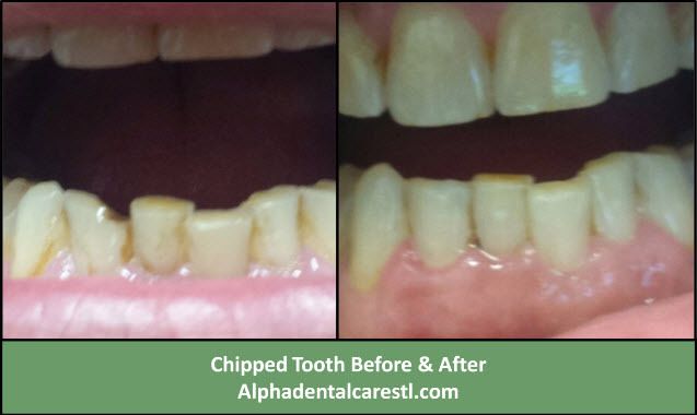 Chipped Tooth Before and After Dental Bonding, Alpha Dental Care Chipped Tooth Before and After Dental Bonding, Alpha Dental Care