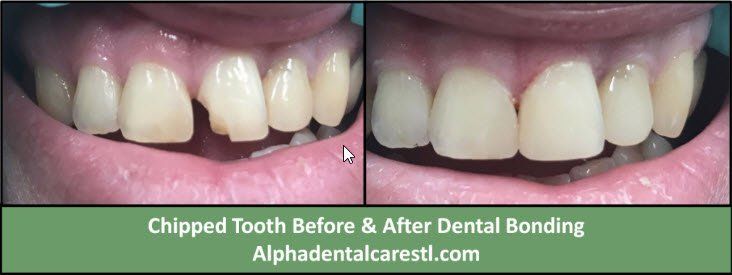 chipped tooth before and after dental bonding example 2 chipped tooth before and after dental bonding, Alpha Dental Care in St. Louis MO