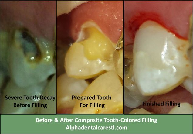 Before and after composite tooth-colored filling, Alpha Dental Care St Louis MO Severely Decayed Tooth Before and After Composite Tooth Colored Filling, Alpha Dental Care