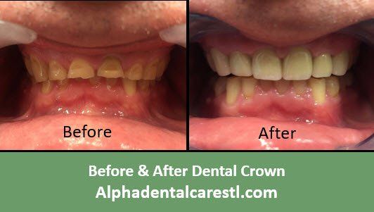 Before & After Dental Crown Example 3, Alpha Dental Care, St. Louis Before & After Dental Crown Example 3, Alpha Dental Care, St. Louis