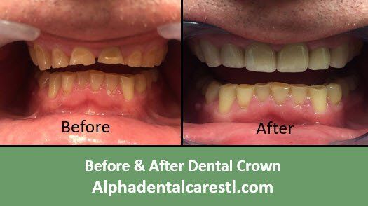 Before and After Dental Crown Example 4, Alpha Dental Care in St. Louis Before and After Dental Crown Example4, Alpha Dental Care in St. Louis