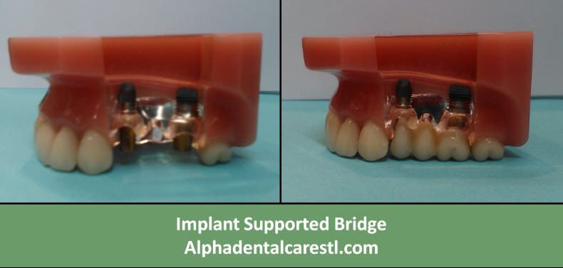 Implant Supported Bridge, Alpha Dental Care St. Louis MO Implant Supported Bridge, Alpha Dental Care St. Louis MO