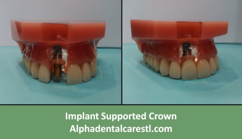 Implant Supported Crown, Alpha Dental Care St. Louis MO Implant Supported Crown, Alpha Dental Care St. Louis MO