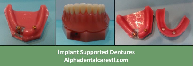 Implant Supported Dentures, Alpha Dental Care St. Louis MO Implant Supported Dentures, Alpha Dental Care St. Louis MO