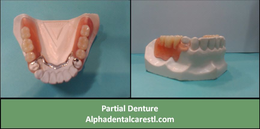 Partial Denture, Alpha Dental Care St Louis MO Partial Denture, Alpha Dental Care St. Louis MO