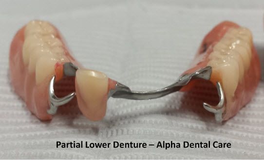 Partial Lower Denture - Alpha Dental Care, St. Louis