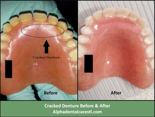 Broken Denture Before and After, Alpha Dental Care Broken Denture Before and After, Alpha Dental Care