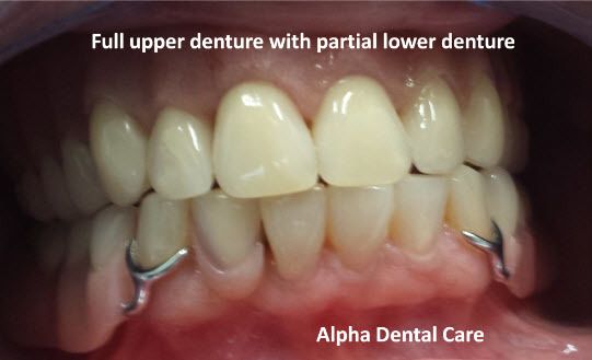 Full upper denture with partial lower denture, Alpha Dental Care in St. Louis