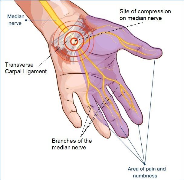 carpal tunnel syndrome