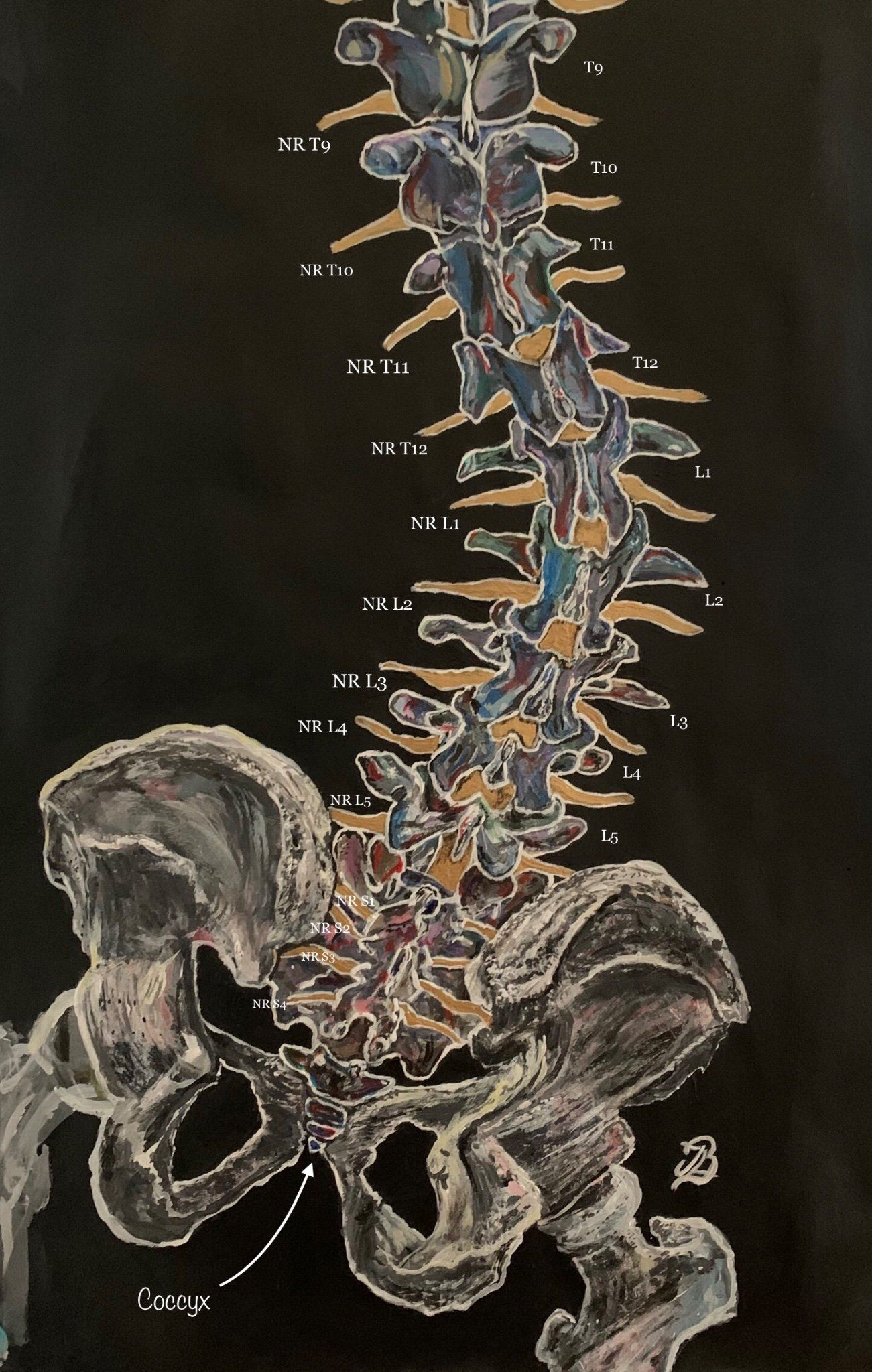 dextroscoliosis of the lumbar spine