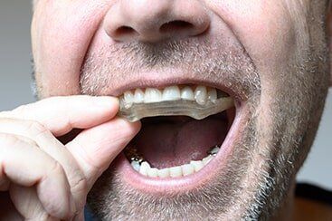 Man placing a bite plate in his mouth