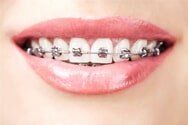 Braces - Utica, NY