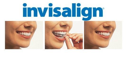 Invisalign Clear Aligners