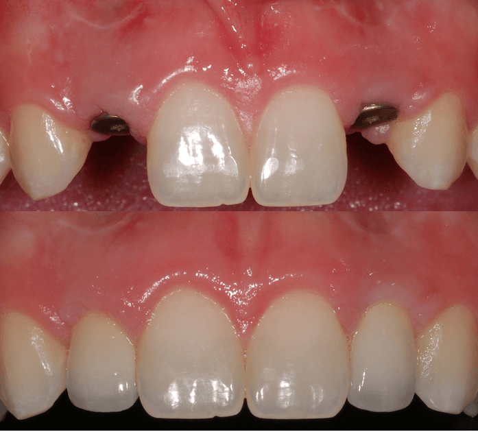 dental implant services in QLD
