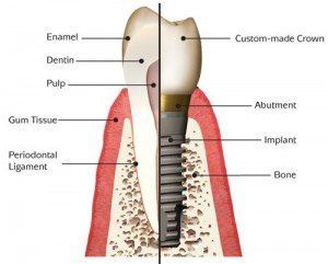 Dental Implant An image showing how dental implants are put in by a dentist serving Redlands