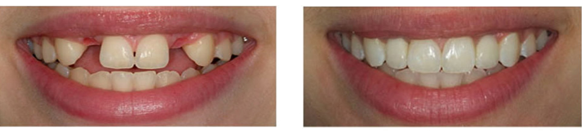 dental implant services in QLD