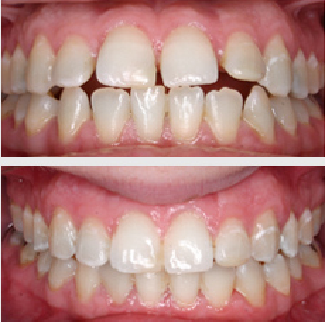 teeth straigthening services in QLD