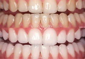 whitening picture services in QLD
