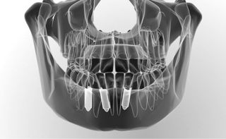 3D-Navigation zur Vermeidung von Risiken bei der Implantation 3D-Navigation zur Vermeidung von Risiken bei der Implantation