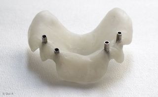 Bohrschablone für exakte Implantat-Positionierung