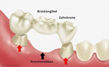 Zahnlücke: Für eine Zahnbrücke müssen (oft gesunde) Nachbarzähne abgeschliffen werden. Zahnlücke: Für eine Zahnbrücke müssen (oft gesunde) Nachbarzähne abgeschliffen werden.