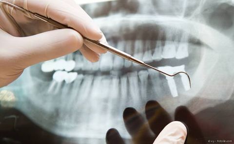 Fragen und Antworten zu Implantaten