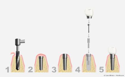 Ablauf einer Implantation