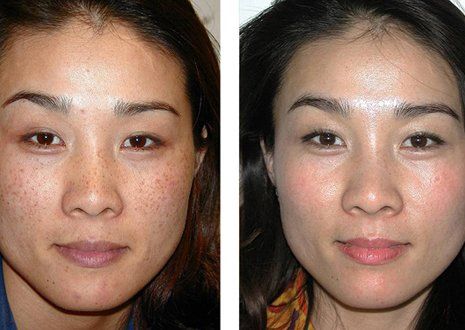 Skin Rejuvenation