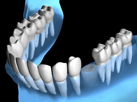 Dente mancante