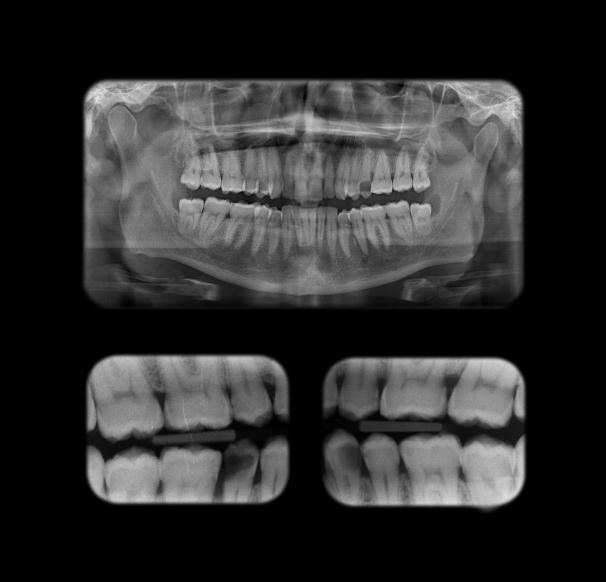 Lastre dentali
