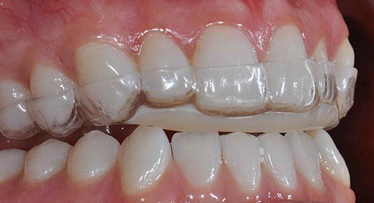 Denti storti