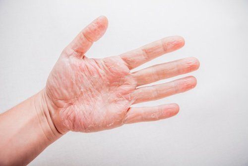 Eczema testing and treatment specialists in Eastern Pennsylvania