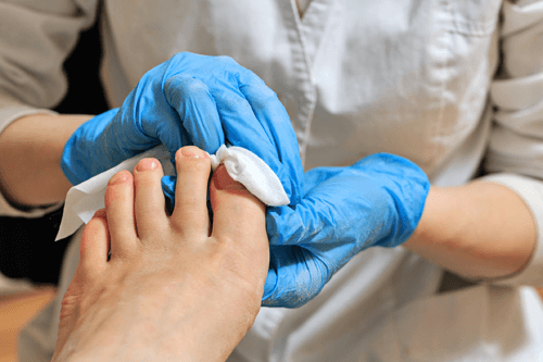Wart Treatment West Seneca, NY