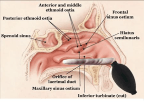 A diagram of a nasal cavity showing the anterior and middle ethmoid ostia