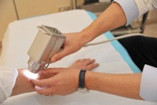 trattamento di verruche, crioterapia trattamento di verruche, crioterapia