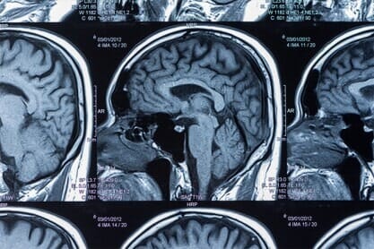 Brain MRI scans showing sagittal sections.