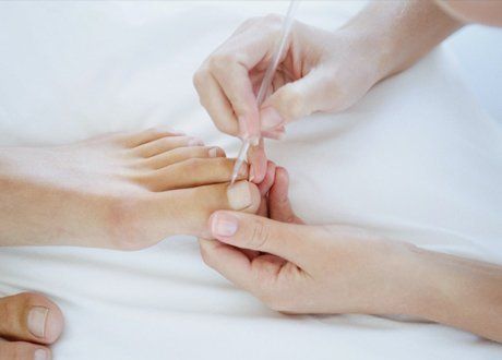 ingrown nail treatments