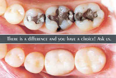 image-369930-Tooth_Colored_Fillings-01.jpg?1453335400899