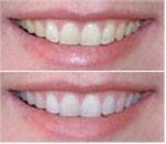 image-369931-Teeth_Whitening-01.jpg?1455903116301 image-369931-Teeth_Whitening-01.jpg?1455903116301