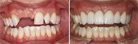 image-369933-DentalBridges-01.jpg?1453335620144
