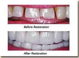 image-369934-Dental_Bonding-01.jpg?1453335729582