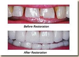 image-369934-Dental_Bonding-01.jpg?1455903171374 image-369934-Dental_Bonding-01.jpg?1455903171374