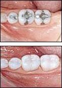 image-423406-370213-Porcelain_Dental_Crowns.jpg?1455903211347 image-423406-370213-Porcelain_Dental_Crowns.jpg?1455903211347