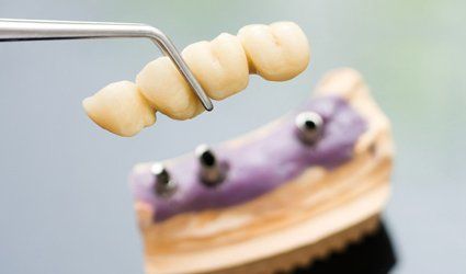 Denture fitting