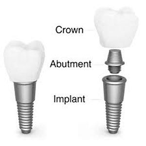 structure of a tooth implant structure of a tooth implant