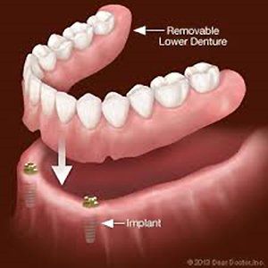 denture implant denture implant