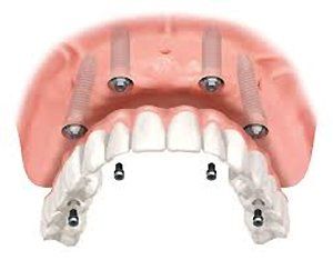 implants for full arch replacement implants for full arch replacement