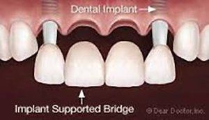 implant supported bridge implant supported bridge