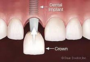 crown implant crown implant