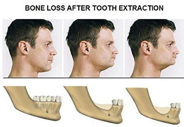 Bone Loss after Tooth Extraction Bone Loss after Tooth Extraction